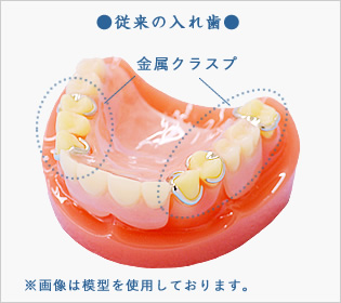 従来の入れ歯