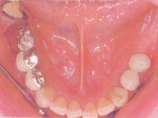 治療前（下顎）