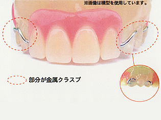 従来の入れ歯02