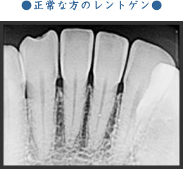 正常な方のレントゲン