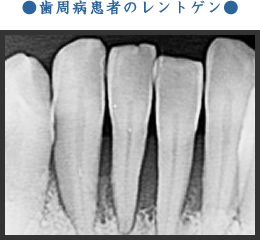 歯周病患者のレントゲン