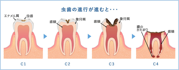 虫歯の進行が進むと・・・