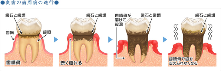 奥歯の歯周病の進行