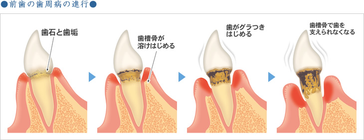 前歯の歯周病の進行